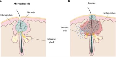 Association of different cell types and inflammation in early acne vulgaris